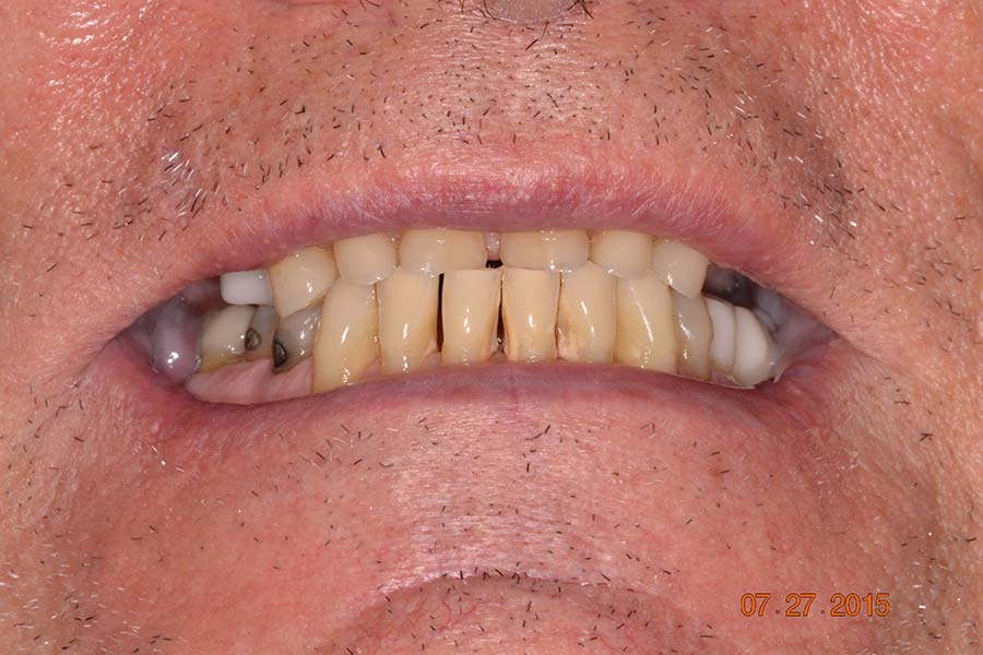 Smile makeover with crowns and implants before and after photos