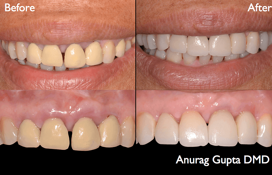 Before and after use of CEREC crowns