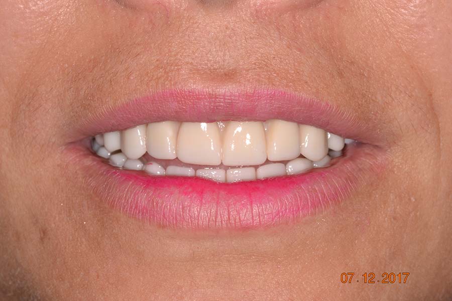 All-on-4 Implant dentures before and after photos
