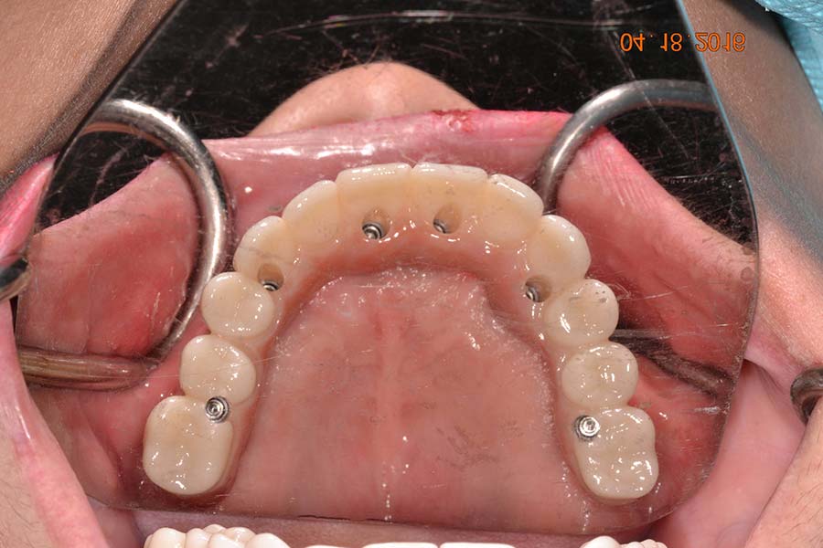 All-on-4 Implant dentures before and after photos