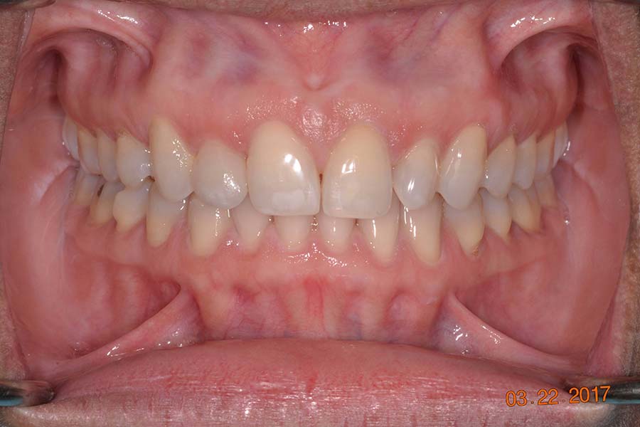 Invisalign before and after photos