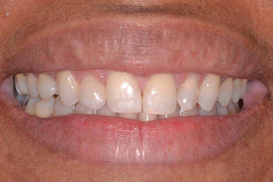 Invisalign before and after photos