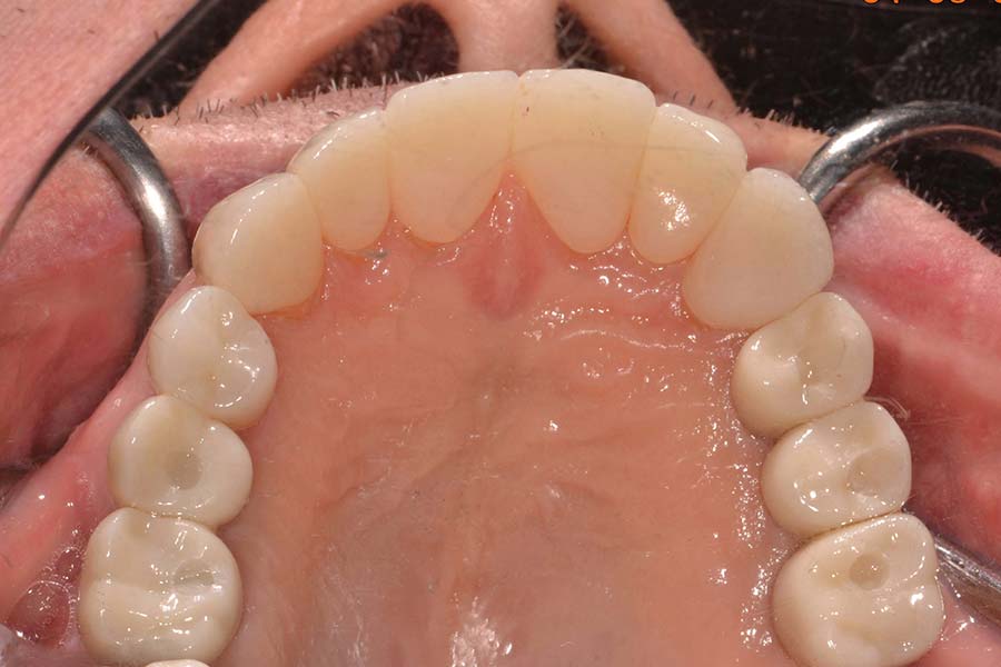 Smile makeover with crowns and implants before and after photos