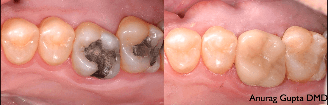 Before and after composite filling