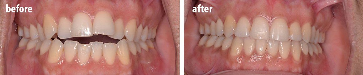 Invisalign before and after 3